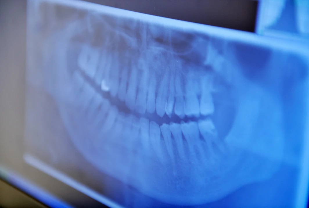 歯周病治療について