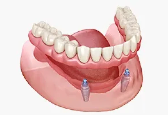 インプラントオーバーデンチャー
