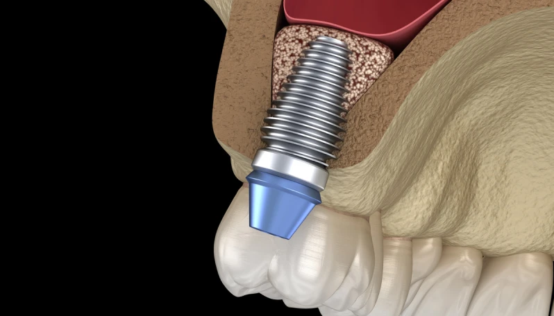 ソケットリフト